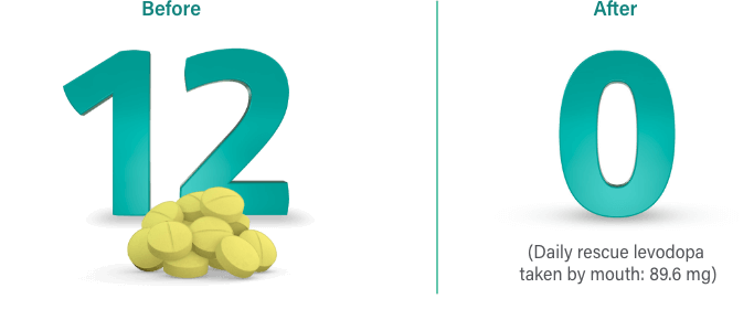 Average levodopa pills per day before starting VYALEV™: 12. After: 0 (Daily rescue levodopa taken by mouth: 89.6 mg).