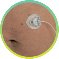 VYALEV™ Pump single cannula attached to skin.